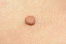 Fibrom