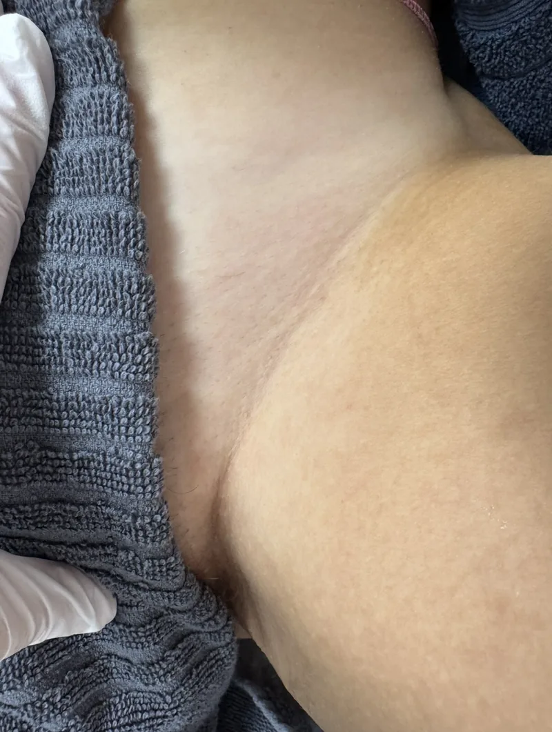 Bikinilinje efter laserhårborttagning