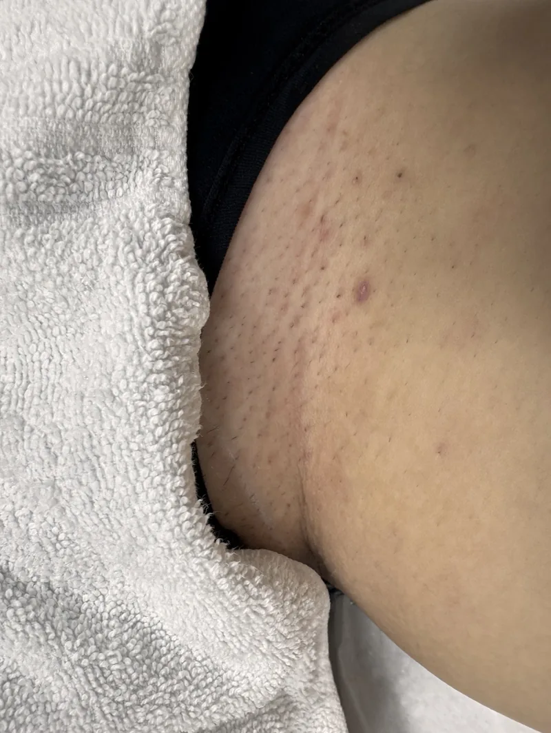 Bikinilinje före laserhårborttagning