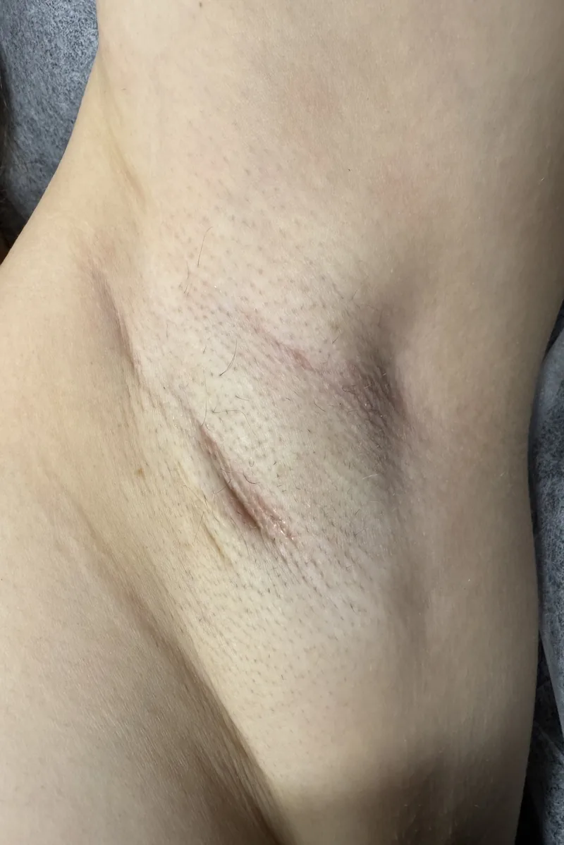 Armhåla efter laserhårborttagning
