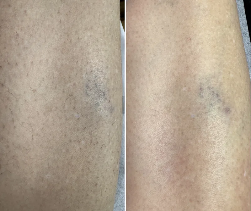 Ben före och efter laserhårborttagning